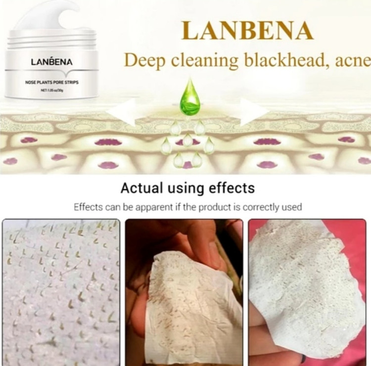 نابودی جوشهای سرسیاه با چسب لانبنا